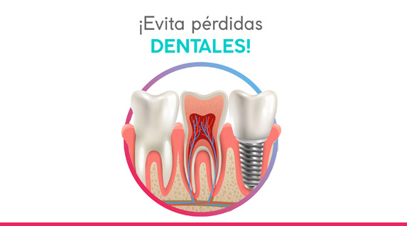 eliminar caries arequipa